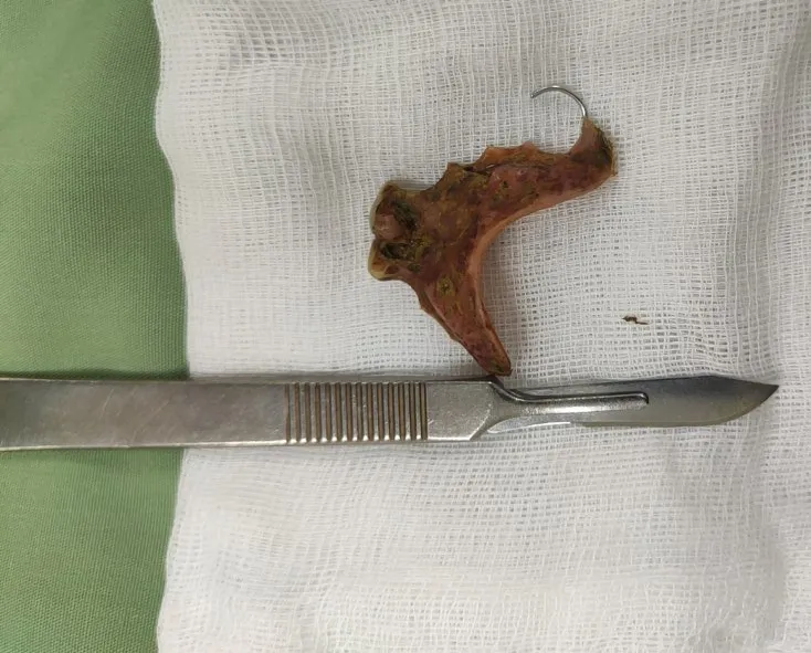 Thủng đại tràng do nuốt phải hàm răng giả ảnh 1