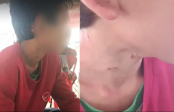 Em T. với những vết thương trên cổ, mặt do bị cha dượng đánh nhiều lần. Ảnh: CTV