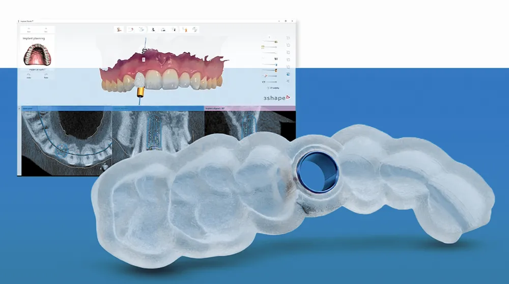 Ứng dụng công nghệ máng định vị kỹ thuật số DSG là công nghệ mang đến sự an toàn trong nha khoa hiện nay