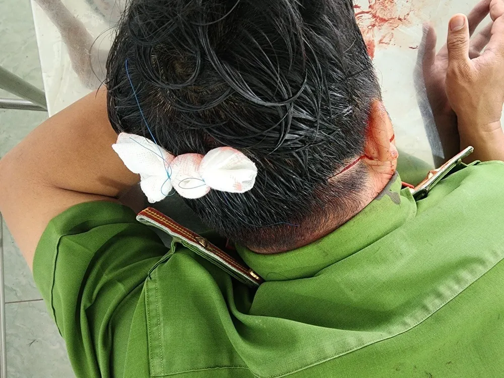 Công an bị thương trong quá trình vây bắt đối tượng.jpg