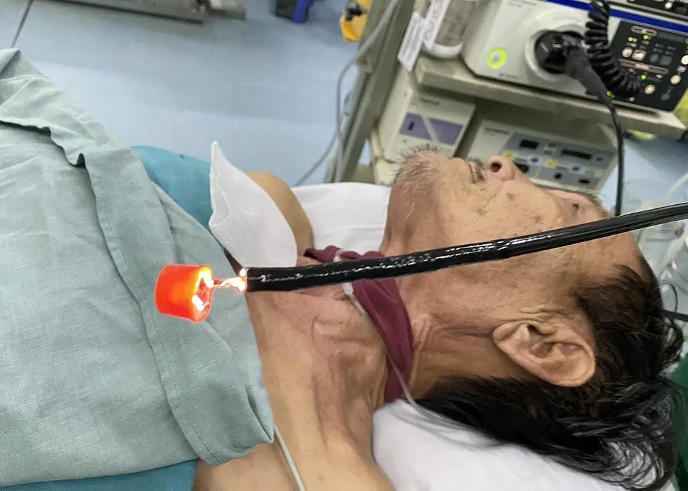 Dị vật là nắp chai dầu nằm trong đường thở của bệnh nhân.jpg