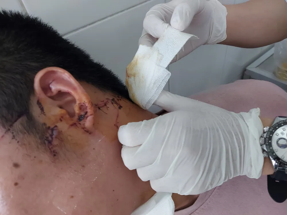 Nạn nhân D. với vết thương ở cổ sau vụ cướp tài sản.jpg