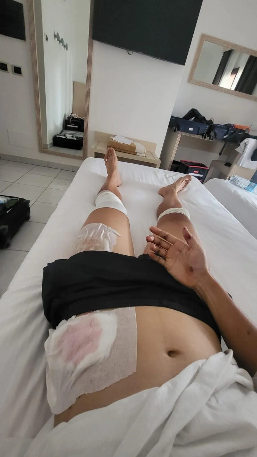 Nguyễn Thị Thật chia sẻ hình ảnh chấn thương sau tai nạn