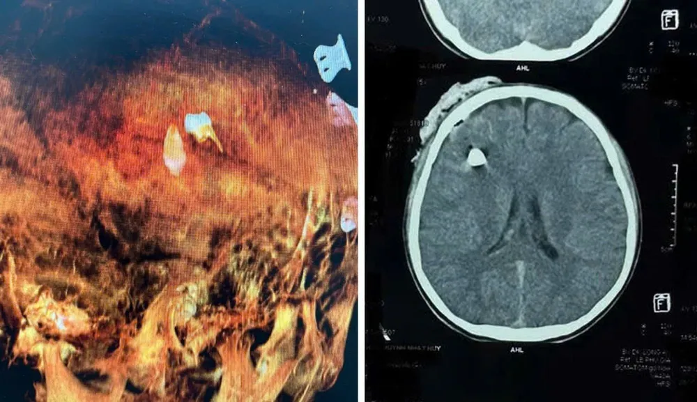 Hình ảnh CT và dựng hình 3D cho thấy vị trí dị vật ở vùng đầu nam sinh