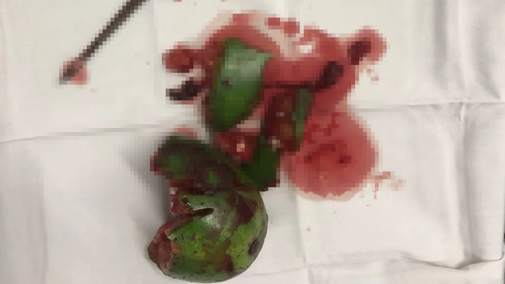 Sử dụng dị vật, cụ ông phải mổ cấp cứu ảnh 1