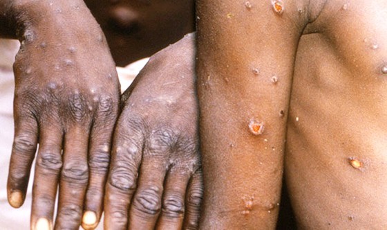 Border gates asked to be strictly controlled to prevent monkeypox outbreak ảnh 2