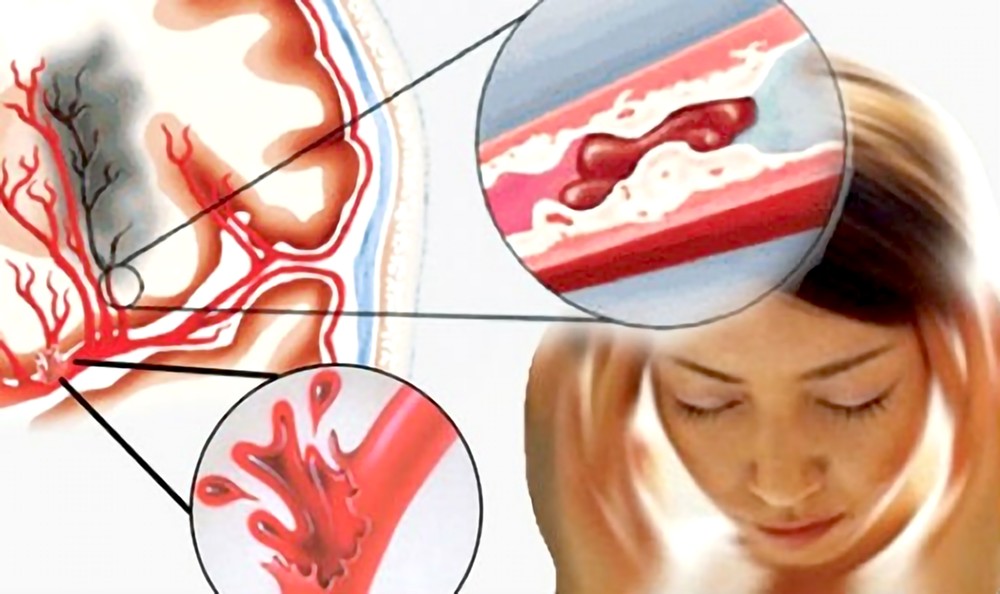 中风脑梗治好后会不会复发？