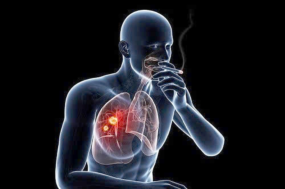 肺癌发病的首位高危因素是吸烟。