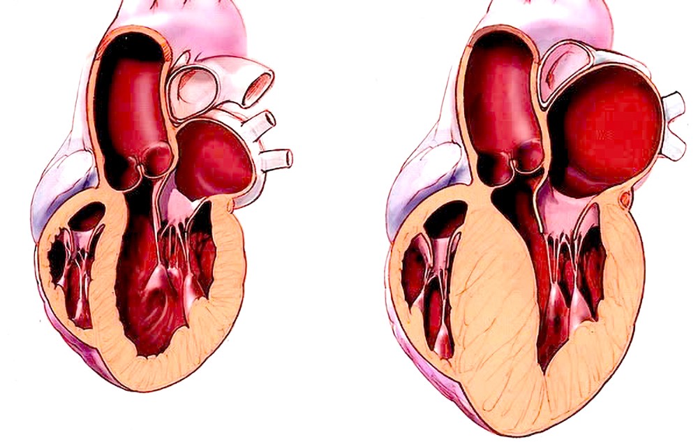 正常心肌与肥厚型心肌。