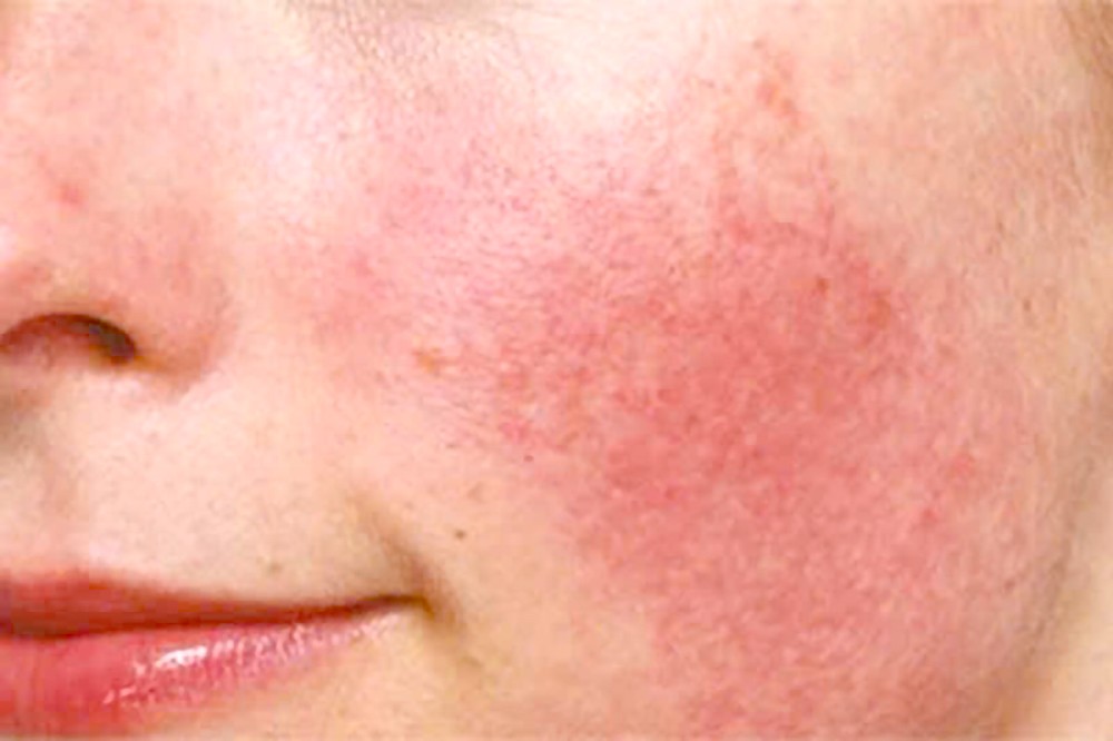 为什么春天容易晒黑？