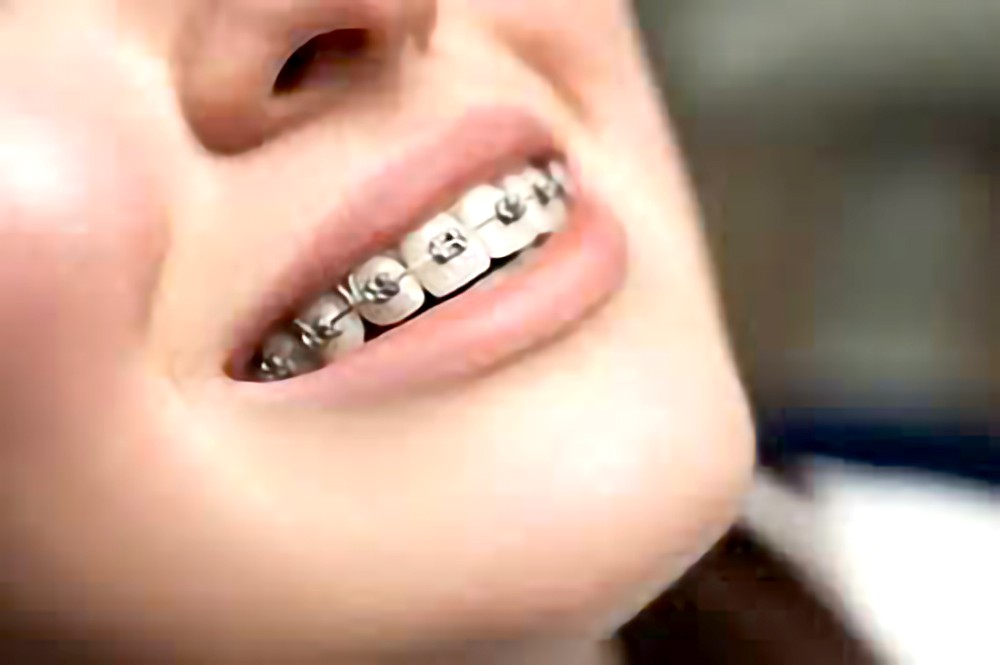 正畸治疗没有年龄限制。