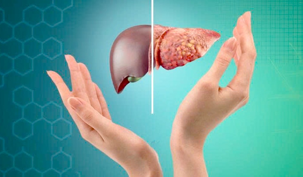 脂肪肝若没有得到适切治疗，会发展成致命的肝病。