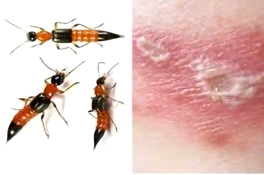 隐翅虫体内的毒素接触皮肤可能造成损害。