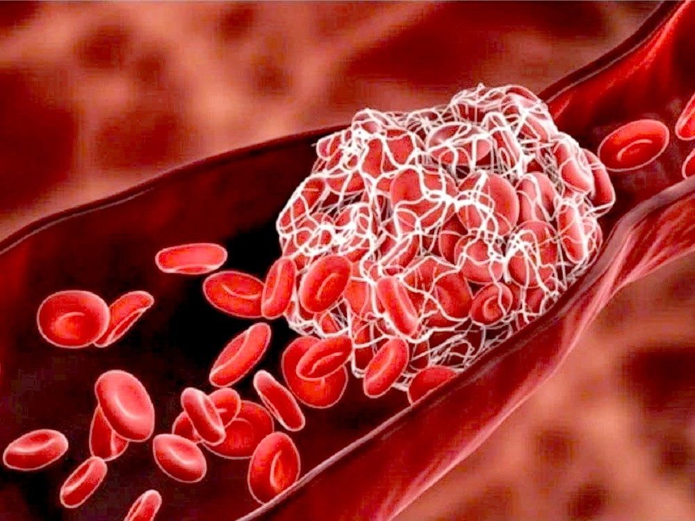 预防血栓从饮食和运动做起。