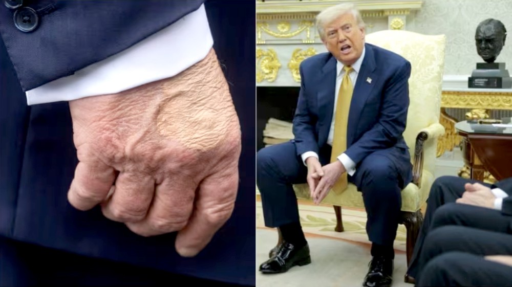 特朗普被诊断患有慢性静脉功能不全