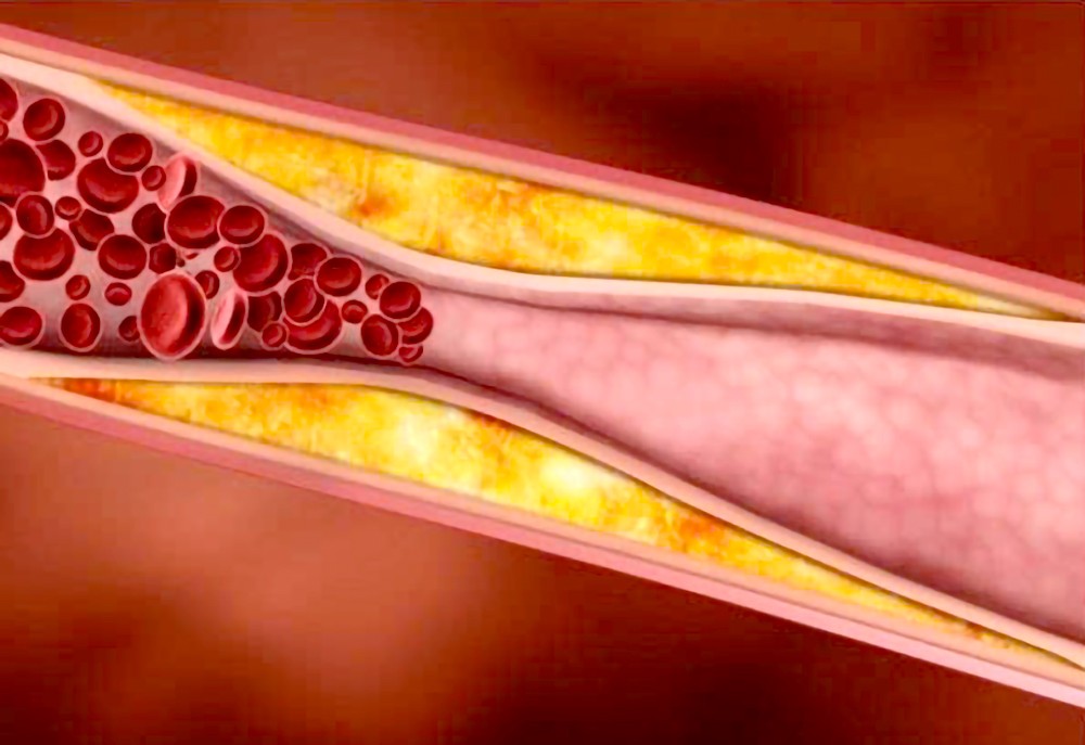 近年来，临床动脉粥样硬化斑块检出率越来越高。