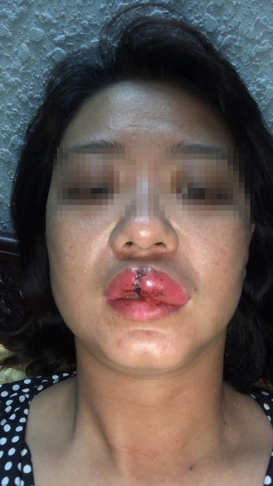 Khởi tố, tạm giam chủ công trình trái phép đánh cán bộ phường gãy răng ảnh 1