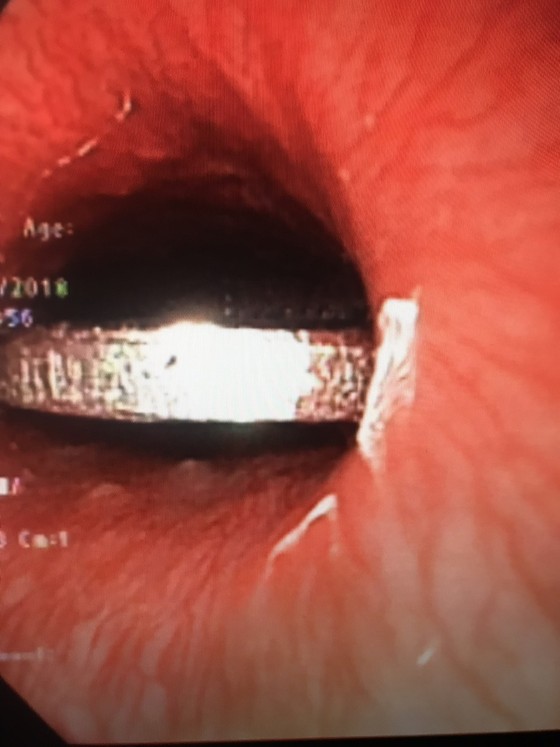 Vừa xem tivi vừa ăn, bé gái nuốt phải dị vật lớn ảnh 2