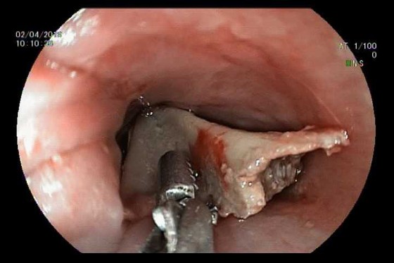 Vừa xem tivi vừa ăn, bé gái nuốt phải dị vật lớn ảnh 1