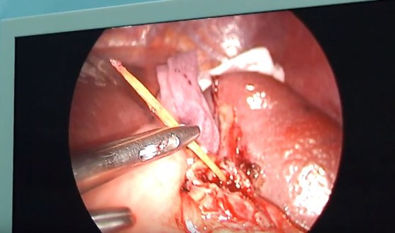 Ngậm tăm đi ngủ, một người đàn ông bị xuyên thủng lá lách ảnh 1