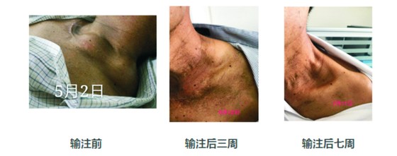 癌症的第五大療法:CAR-T 細胞免疫療法 ảnh 2