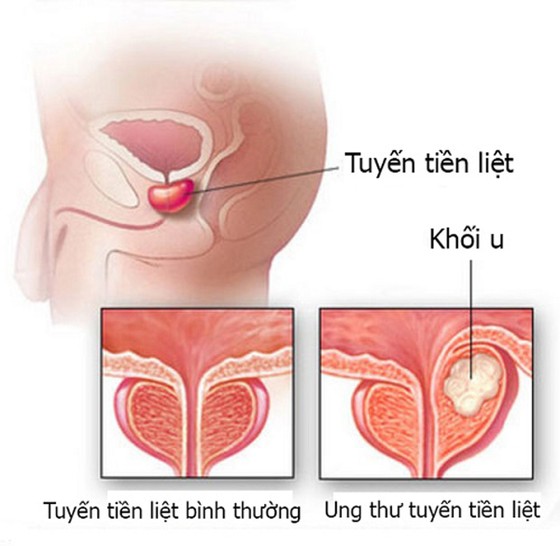 Hơn 1.275 trường hợp mắc mới ung thư tuyến tiền liệt mỗi năm ảnh 1