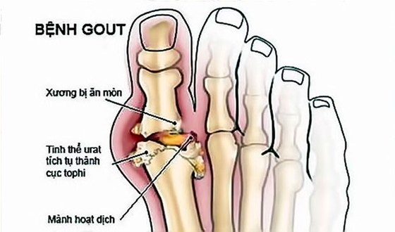 Nguy cơ lạm dụng Corticoid điều trị bệnh xương khớp ảnh 2