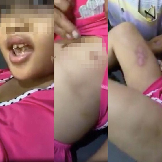 Bắt người cha dượng hành hạ, châm thuốc lá vào người bé gái 6 tuổi ảnh 1