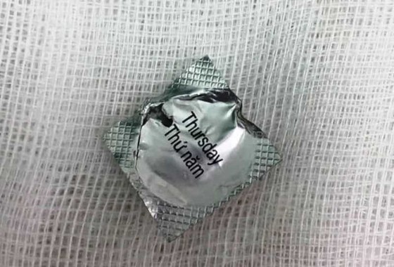 Bệnh nhân nuốt viên thuốc còn nguyên vỏ đâm vào thực quản ảnh 1