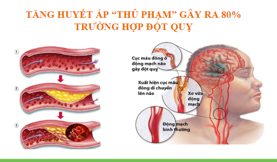 25% dân số mắc bệnh về tim mạch và tăng huyết áp ảnh 1