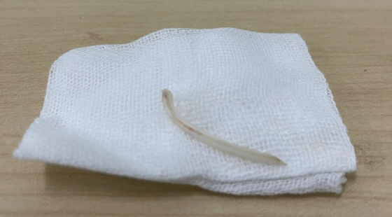 Xương cá được lấy ra khỏi thanh môn của bệnh nhân