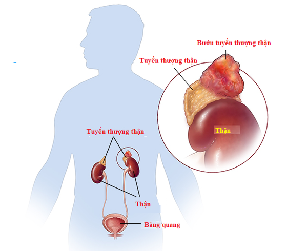 Phẫu thuật thành công bệnh nhân có bướu hai bên tuyến thượng thận kích thước lớn, hiếm gặp ảnh 1