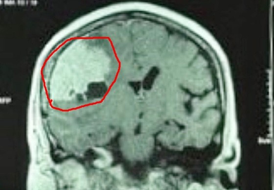 Khối u màng não kích thước lớn (khoanh đỏ) trong não bệnh nhân