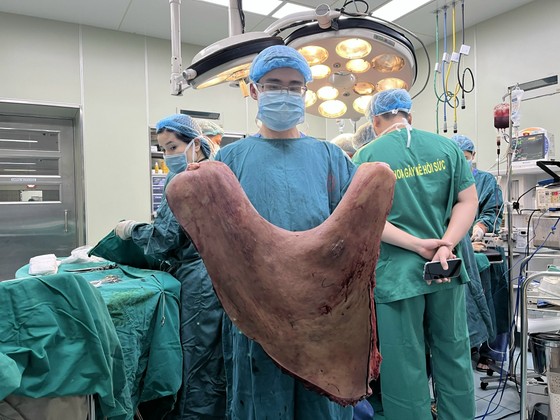 Cắt bỏ thành công khối u khổng lồ nặng 9kg trên lưng một chàng trai ảnh 1