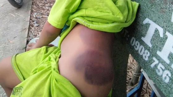 Em K, học sinh lớp 1 Trường Tiểu học Bình Hữu bị đánh bầm tím ở phần hông. Nguồn: DANTRI.COM.VN