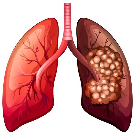 Ung thư phổi-Nguy cơ mắc bệnh cao