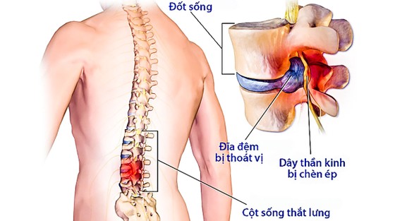 Nguyên nhân gây đau lưng, thoát vị đĩa đệm ảnh 2