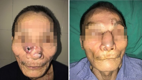 左起：接受整形手術前與後的皮膚癌患者阿Q。
