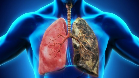 除吸煙外 肺癌還有６大禍首。（示意圖源：互聯網）