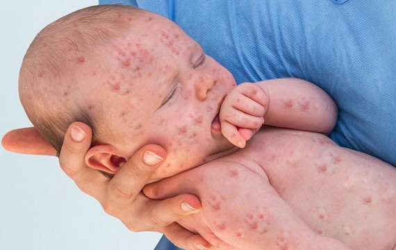 南太平洋島國薩摩亞26日宣佈，自10月中旬出現麻疹疫情以來，該國死於麻疹的患者已由最初的3人激增至32人。（示意圖源：互聯網）