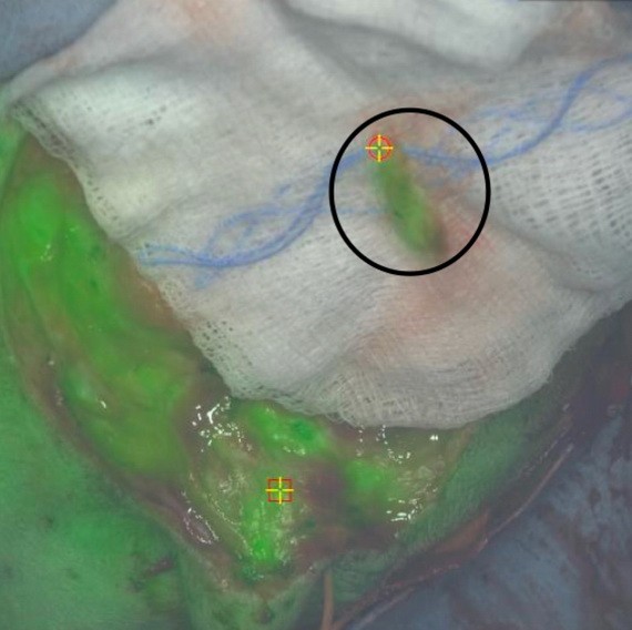 ICG 染劑使狗胸部癌細胞發出綠色螢光，同時也發現癌細胞已擴散到淋巴結（黑色圓圈處）。（圖源：Penn Vet）