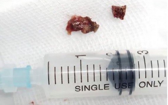 經內窺鏡手術從患者的左側氣管取出的碎片雞骨異物。（圖源：院方提供）