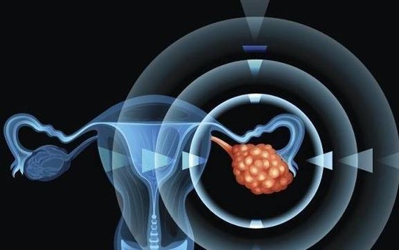 身体或发出３个卵巢癌“红色信号”