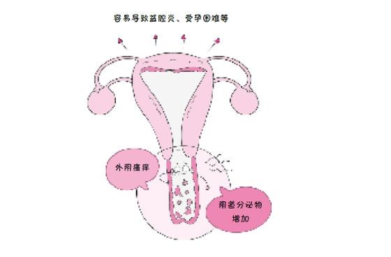 阴道炎对备孕有哪些影响？