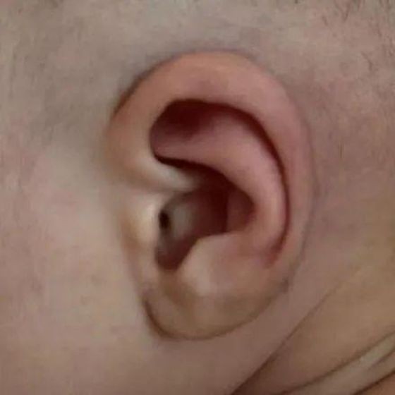 新生宝宝耳朵小、耳朵皱或是耳廓畸形