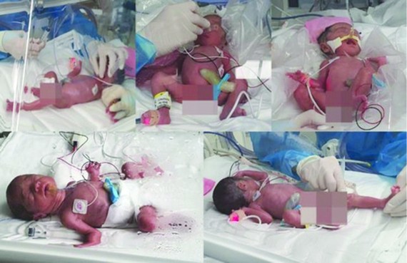 據韓聯社報導，據首爾大學醫院19日消息，韓國陸軍第17師的一對大尉夫婦前一天晚上10時許喜獲五胞胎。