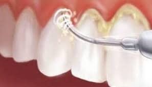 洗牙后出现４状况是牙周病警讯！