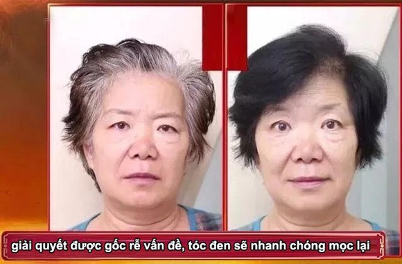 Tóc bạc 10 năm biến thành tóc đen, trị tóc bạc tận gốc! ảnh 1
