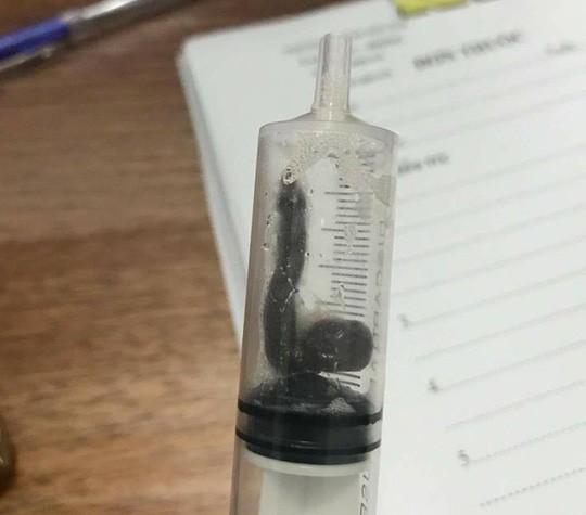 Gắp 2 con vắt dài sống ký sinh trong mũi cháu bé và cụ bà suốt gần 1 tháng ảnh 1