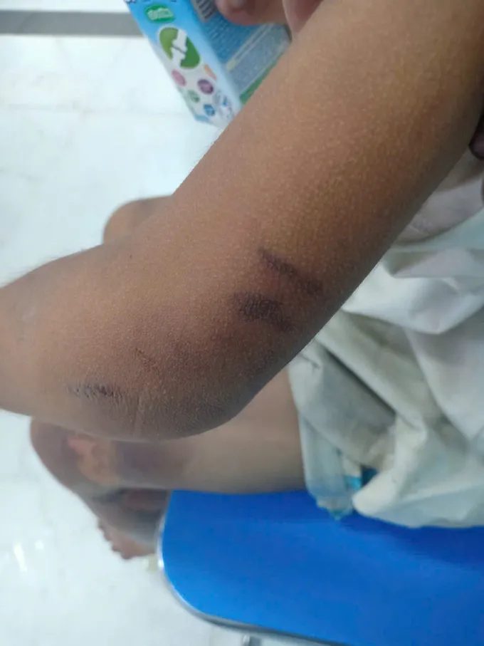 Các thương tích còn lại rải rác trên người cháu K. khoảng 30% 2e9ab2b65107f759ae16.jpg